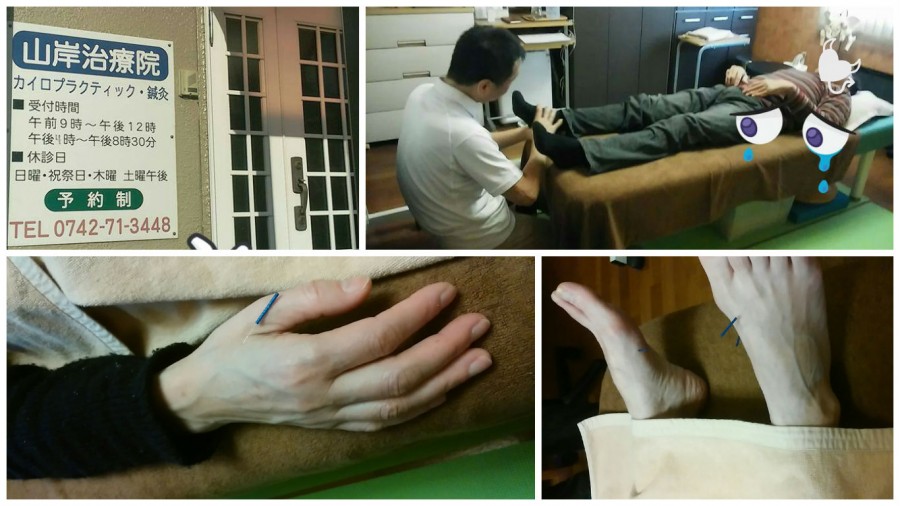 針治療って痛いの??もちろん痛くないですよ!